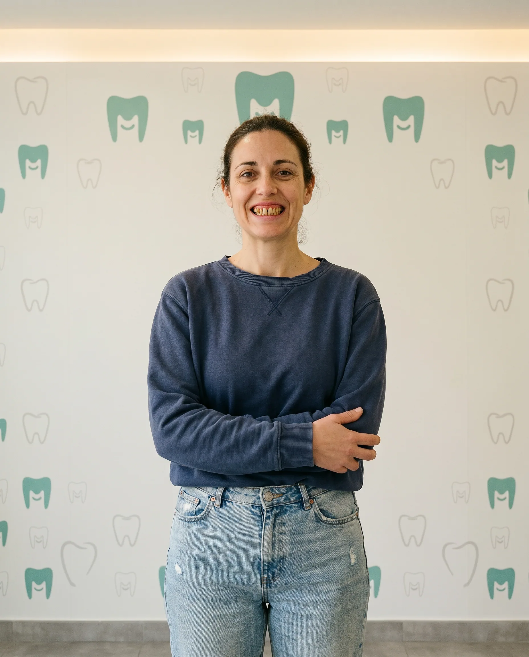 Caso de carillas feldespáticas antes — sonrisa gingival